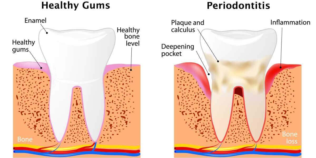 Periodontal Disease (Gum Disease): Causes, Symptoms & Treatment