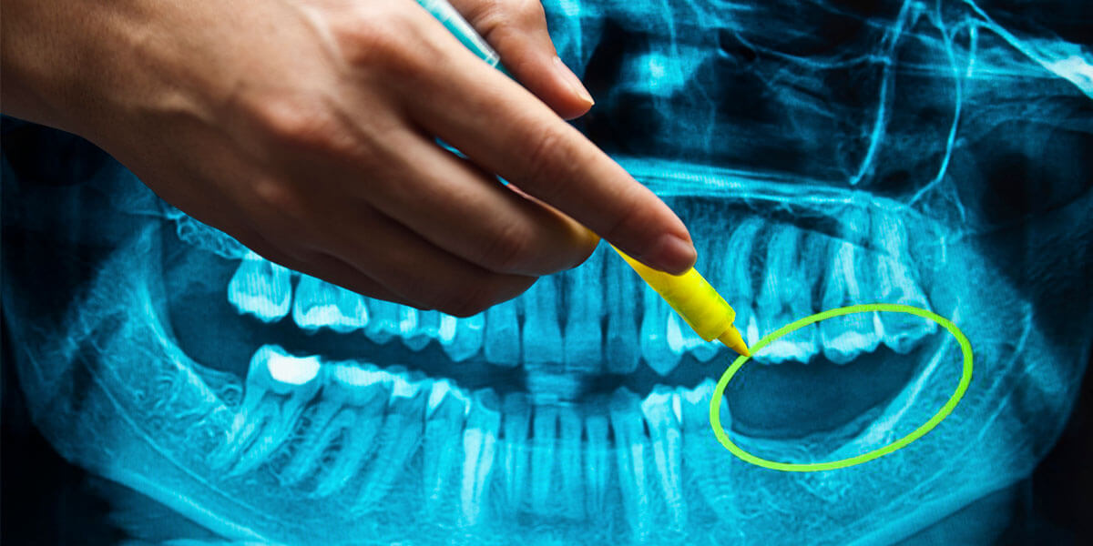 Digital Dental X-Ray showing tooth and bone loss