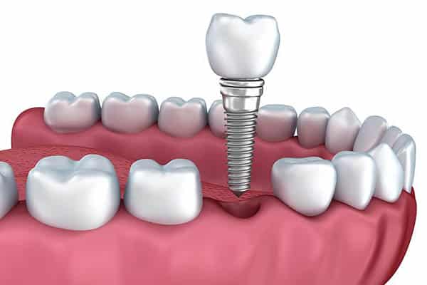 Implant supported bridge illustration