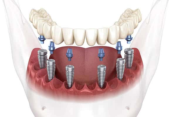 Implant supported bridge illustration